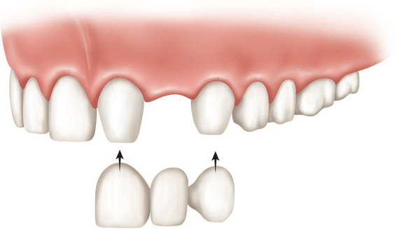 پروتز های مصنوعی  دندان